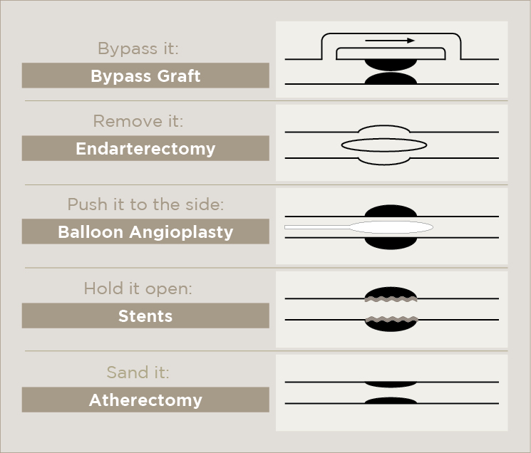 how to open endovascular blockages infographic