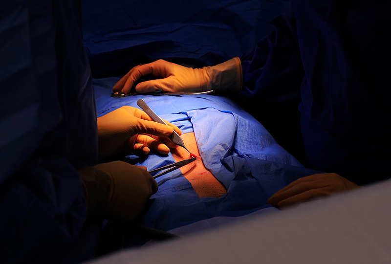 Scarless Hernia Repair operating room in Jupiter Florida